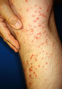 Image of stings from fireants (not mine)